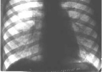Рис. 40. Рентгенограмма при пролапсе митрального клапана: тень сердца