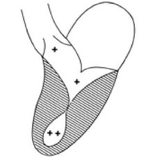 Рис. 53. Схема возникновения обструкции левого желудочка в средней