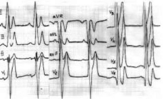 Рис. 59. Электрокардиограмма при карнитиновой кардиомиопатии: «гигантские»
