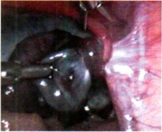 Рис. 13-4. Эндоскопическая картина перекрута кисты правого яичника.