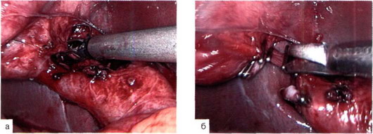 Рис. 14-19. Коагуляция (а) и пересечение (б) пузырной артерии после клипирования.