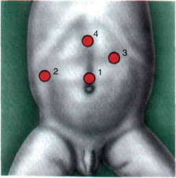 Рис. 20-2. Схема расположения троакаров при лапароскопической пилоромиотомии:
