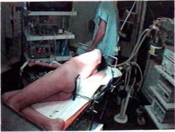 Положение пациента на операционном столе при видеоторакоскопической операции.