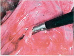 Рис. 26-5. Выделение нижнедолевой артерии.