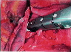 Рис. 26-6. Наложение линейного эндостепле-ра на артерию.
