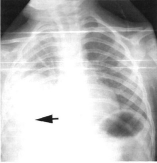 Рис. 27-1. Обзорная рентгенограмма грудной клетки больного с эмпиемой плевры.