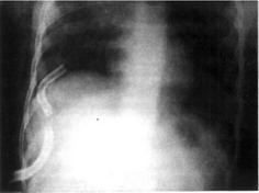 Рис. 29-1. Обзорная рентгенограмма органов грудной клетки. Инородное тело плевральной