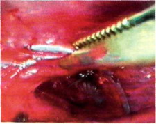 Рис. 29-2. Инородное тело плевральной полости слева - хирургическая игла.