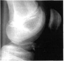 Рис. 32-10. Перелом межмыщелкового возвышения большеберцовой кости, III тип.