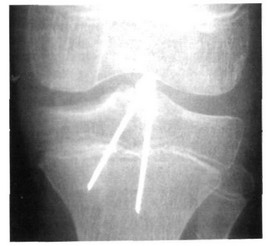 Рис. 32-11. Перелом межмыщелкового возвышения большеберцовой кости, IV тип.