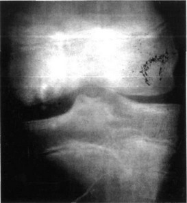  Рассекающий остеохондроз (болезнь Кенига). Рентгенотрамма.