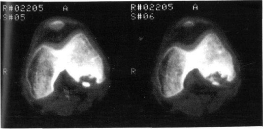 Рис. 33-2. Рассекающий остеохондроз (болезнь Кенига). Компьютерная томограмма.