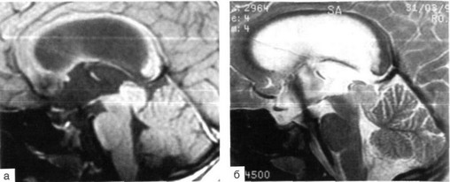 Рис. 37-8. МРТ головы: окклюзионная водянка, которая обусловлена глиальной опухолью